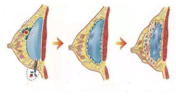 科普假体隆胸后乳房僵硬疼痛的原因及解决方法(图3)